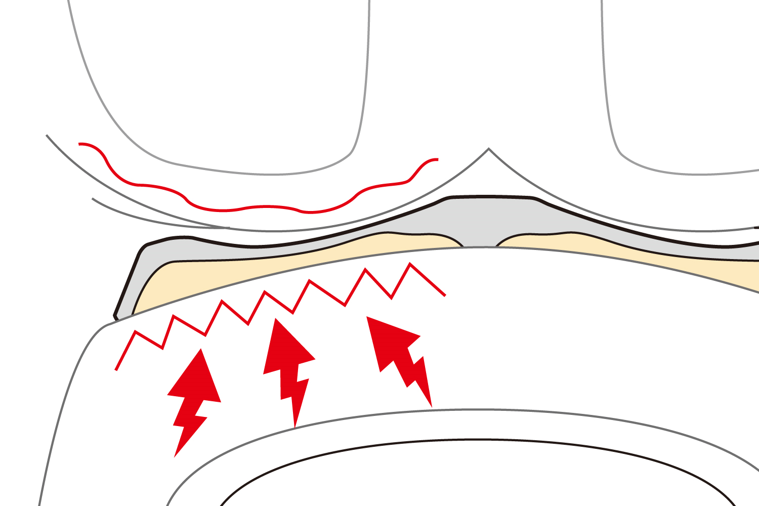 ゲルザブで採用しているエクスジェル